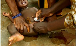 Cameroun-Mutilations sexuelles féminines :  Le combat de la fondation Fevadis