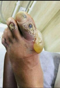 Cameroun-rentrée des activités d’Apéro santé : l’antibioresistance et le pied diabétique au cœur des echanges