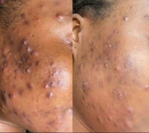 Cameroun- Centre médical les promoteurs de la bonne santé : Acné, quand et comment la traiter ? La dermatologue, Dr Chiago Tietche Sonia anime une conférence sur le sujet