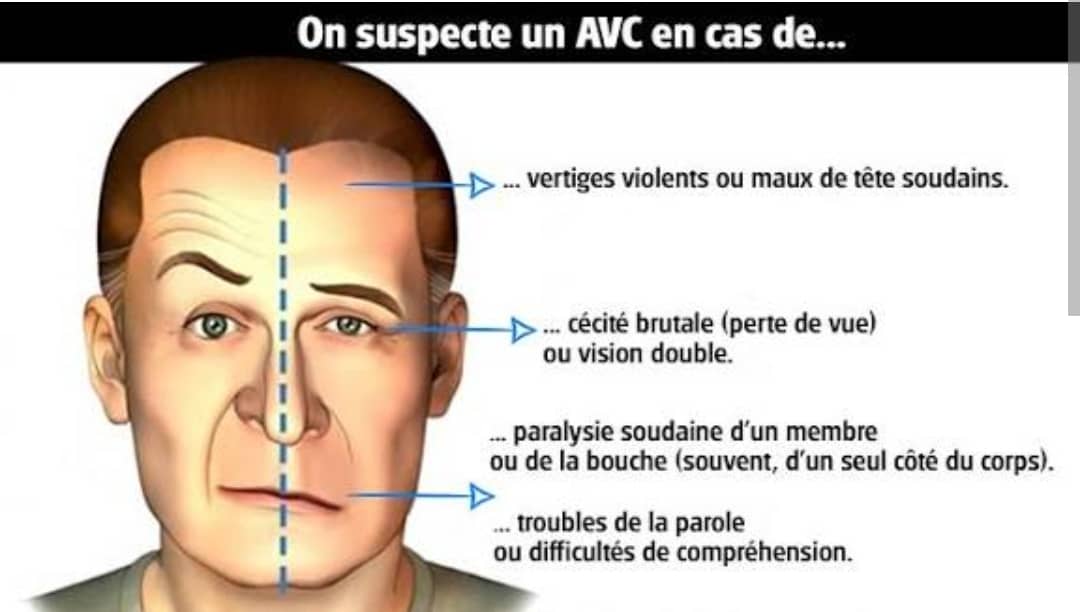 AVC : La sonnette d’alarme est tirée